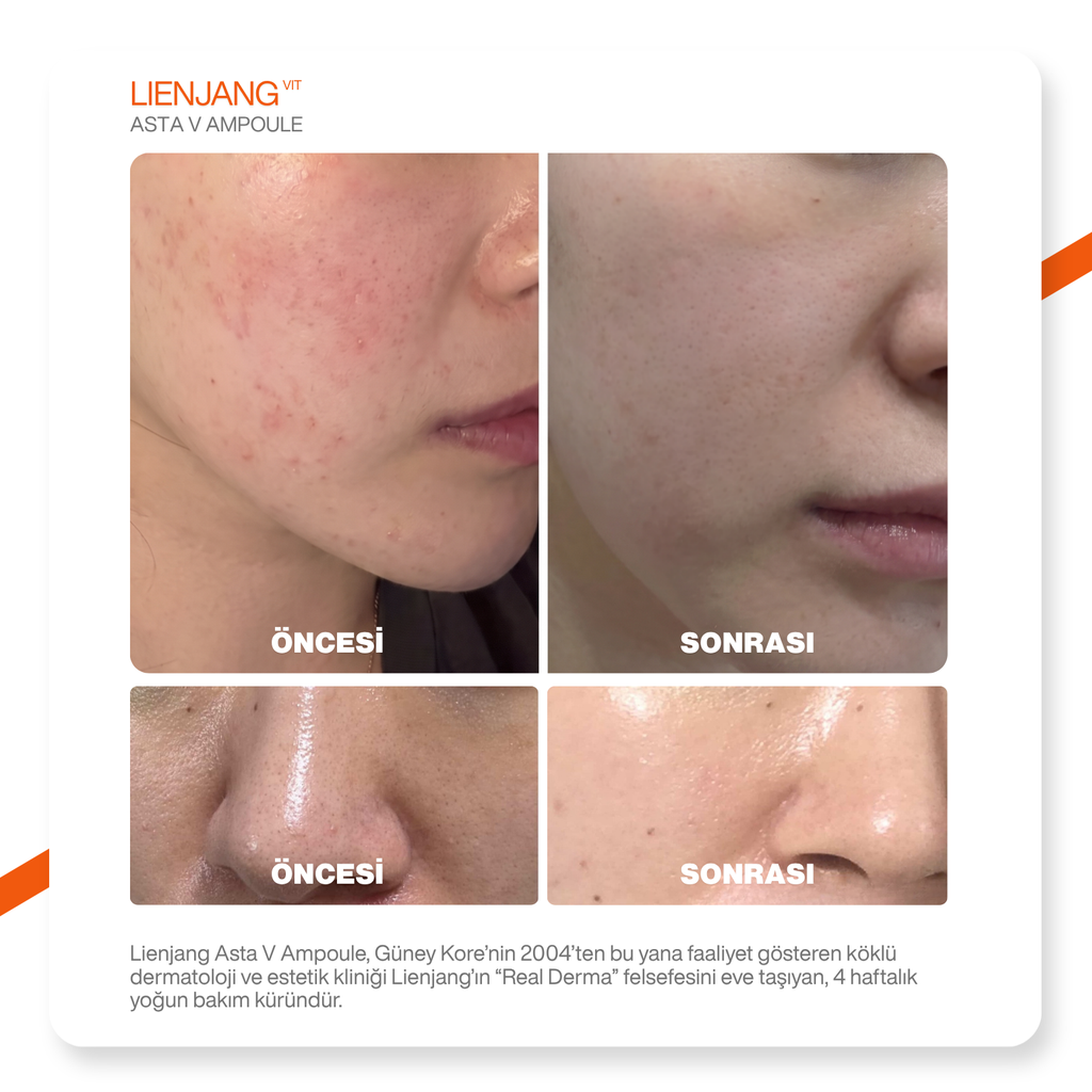 %13 Saf C Vitamini & Astaksantin | Leke & Kırışıklık Karşıtı | Yoğun Aydınlatıcı | Ton Eşitleyici Ampül Seti 4x10ml