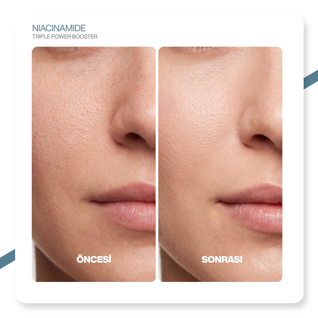 V'anhalla %15 Niacinamide Serum | Gözenek Sıkılaştırıcı | Sebum Dengeleyici | Aydınlatıcı Serum 30ml