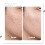 v'anhalla Koyu Leke Karşıtı | %3 Traneksamik Asit | Cilt Tonu Eşitleyici | Aydınlatıcı Serum 30ml